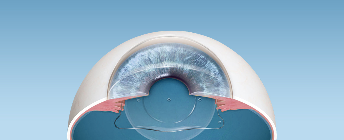 렌즈삽입수술 EVO+ICL은 각막손상이 없고, 빛 번짐 및 안구건조증이 거의 없습니다.